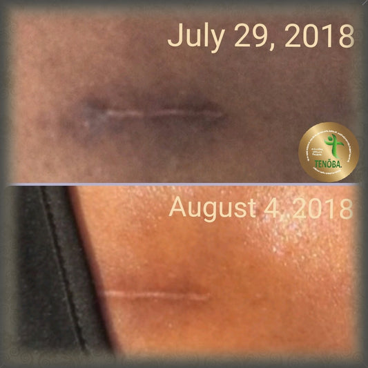 Skin Enhancing Serum (Scars Stretch Marks)