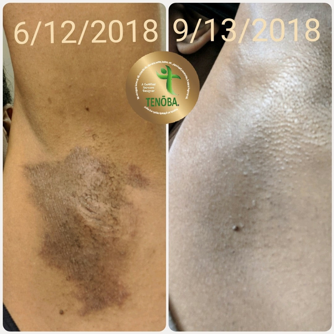 Skin Enhancing Serum (Intertrigo)
